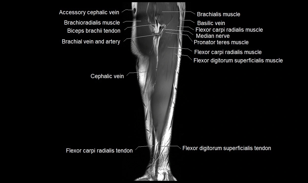 MRI 3T forearm coronal cross sectional anatomy image 6.webp